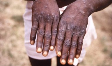 Santé : Après covid-19 , voici la nouvelle pandémie qui attaque le monde
