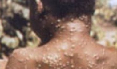 L’OMS déclare une nouvelle pandémie dans 70 pays, comme une urgence sanitaire mondiale
