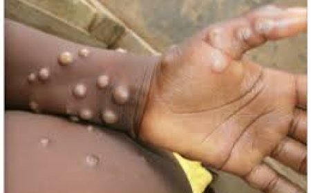 RDC : Monkey pox, une nouvelle épidémie qui refait surface à Kinshasa