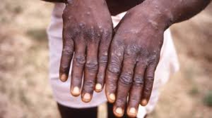Flambée de cas suspects de Monkeypox en RDC : plus de 220 notifications en une semaine