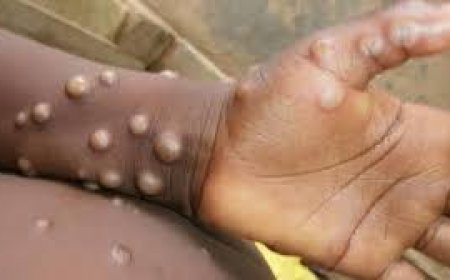Sud-Kivu : 3 décès sur les 239 cas de Monkey pox notifiés en 6 mois