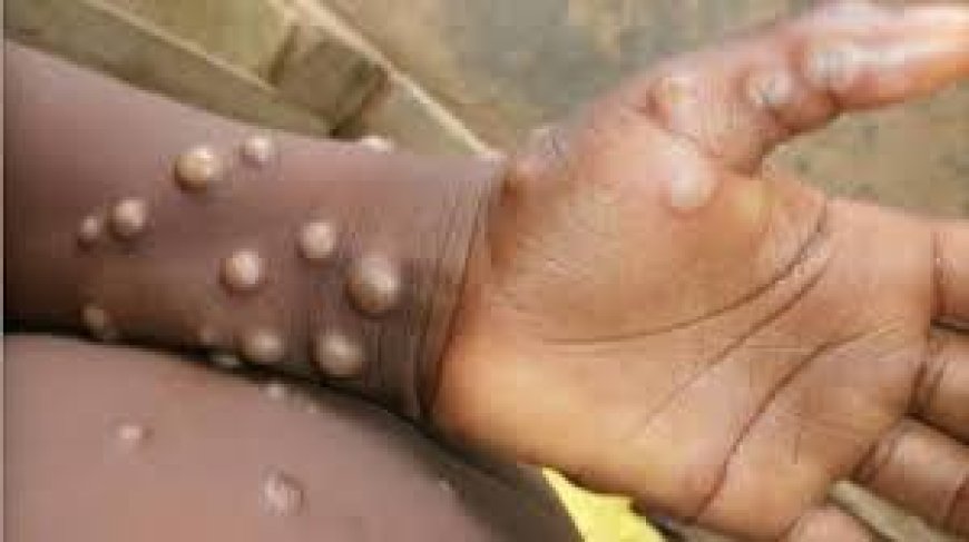 Sud-Kivu : 3 décès sur les 239 cas de Monkey pox notifiés en 6 mois